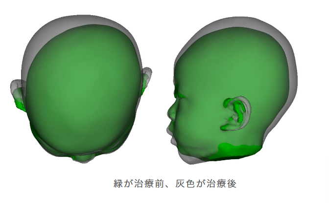 月齢6か月から治療開始－頭蓋骨矯正ヘルメット治療の実例 | 赤ちゃんの