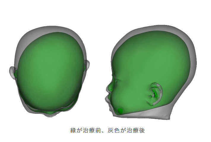 アイメット Aimet 赤ちゃん 頭 矯正-